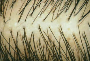 Densité capillaire avant Folicerin Shampoing