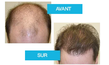 Profolan : Résultat avant/après stimulation repousse cheveux (cas 3)